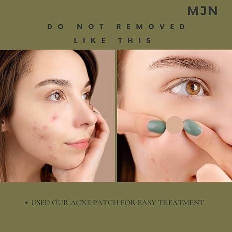 Acne Clearing Pimple Patches (Pack of 2) 144 Patches